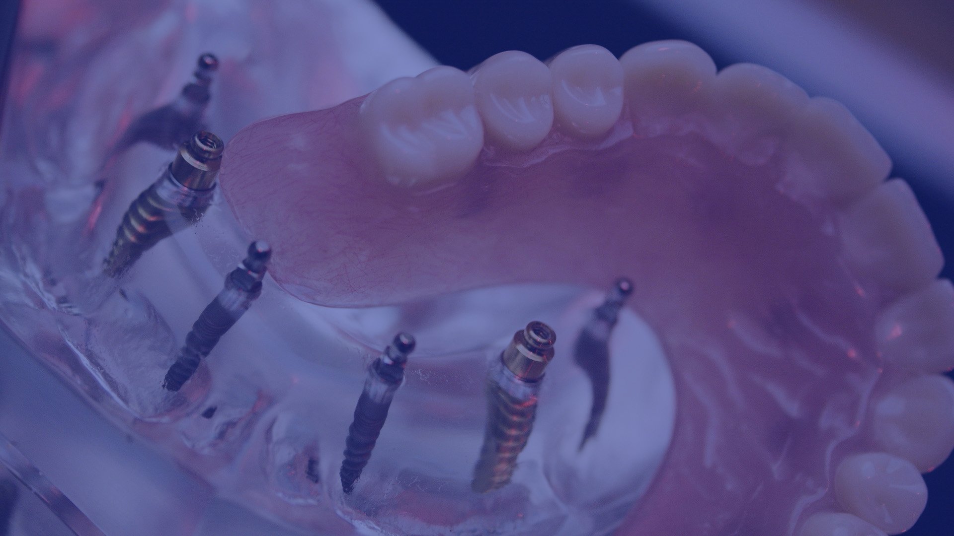 Noblesville's Premier Dental Implant Providers