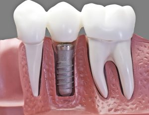 The Road to Recovery: What to Expect After Getting Dental Implants