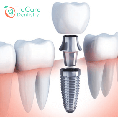 Choosing the Right Dental Implant for You: Materials and Methods Explained