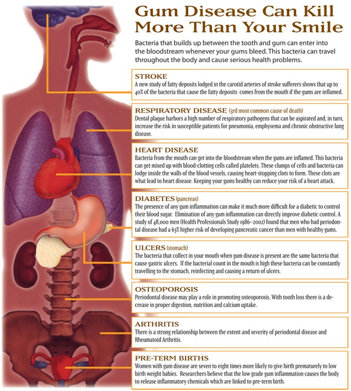 Understanding the Link Between Oral Health and Heart Disease: What Research Shows