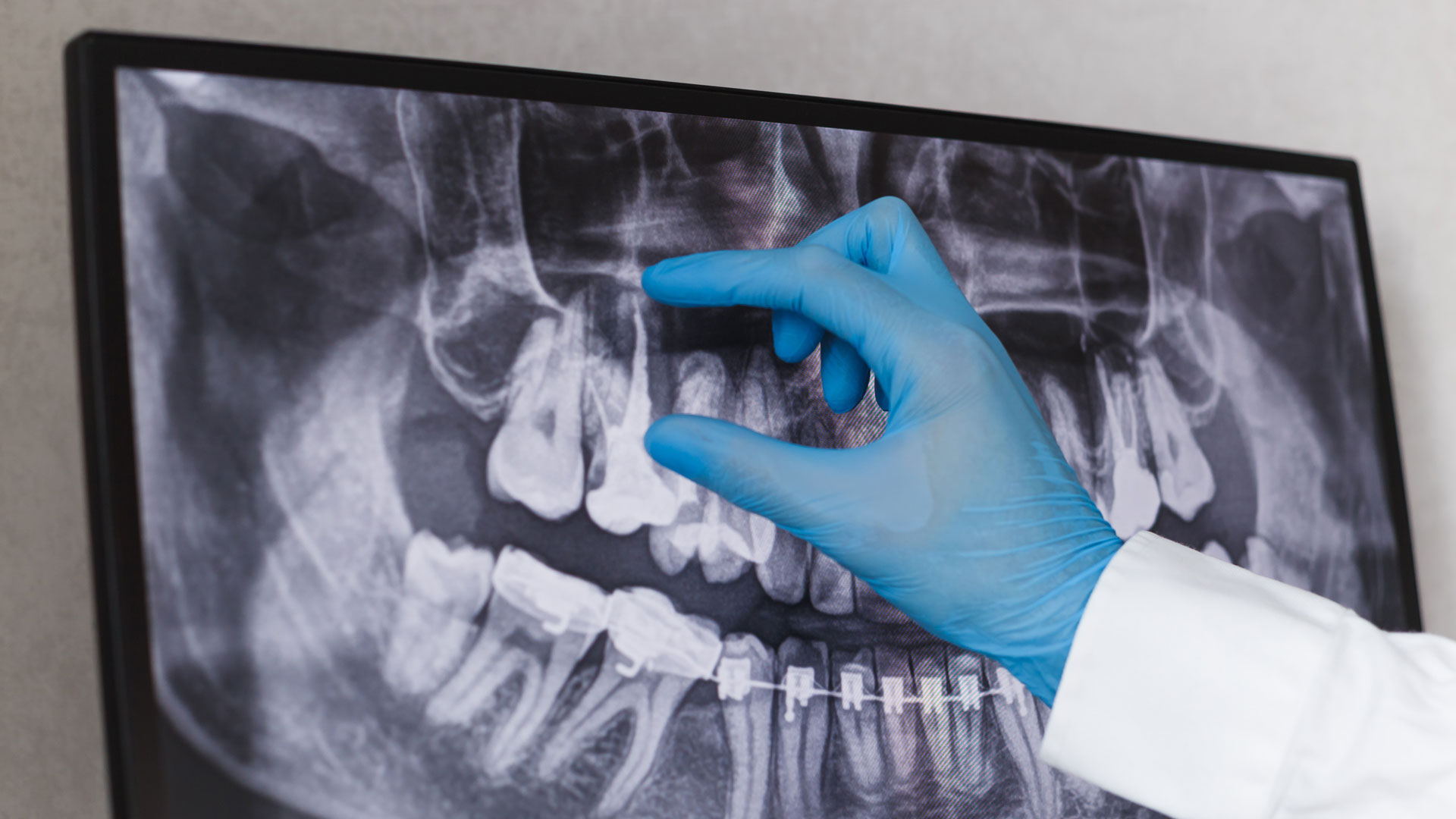 Understanding the Need for Dental X-Rays