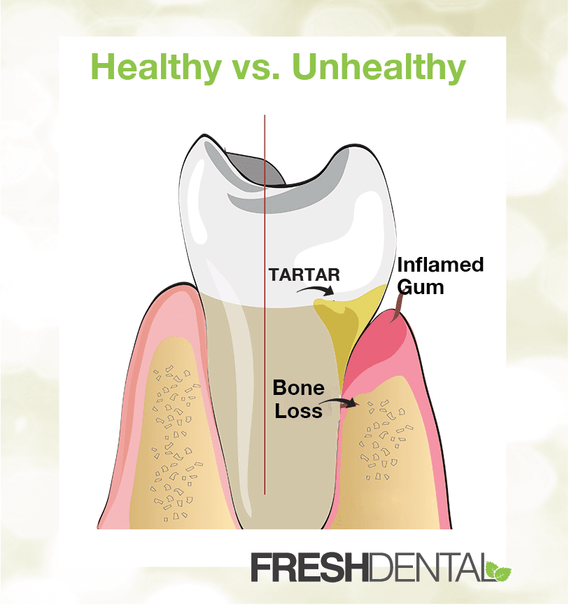 The Signs of Unhealthy Gums and How to Treat Them