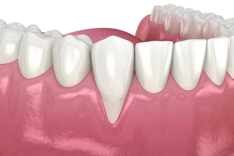 Understanding Gum Grafting: Procedure and Benefits
