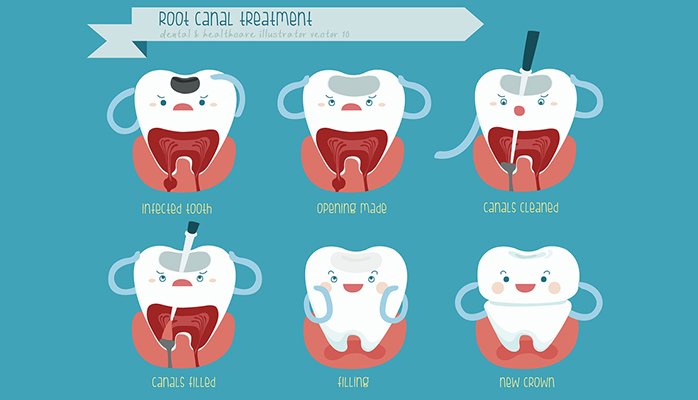 Managing Pain After a Root Canal: Effective Strategies