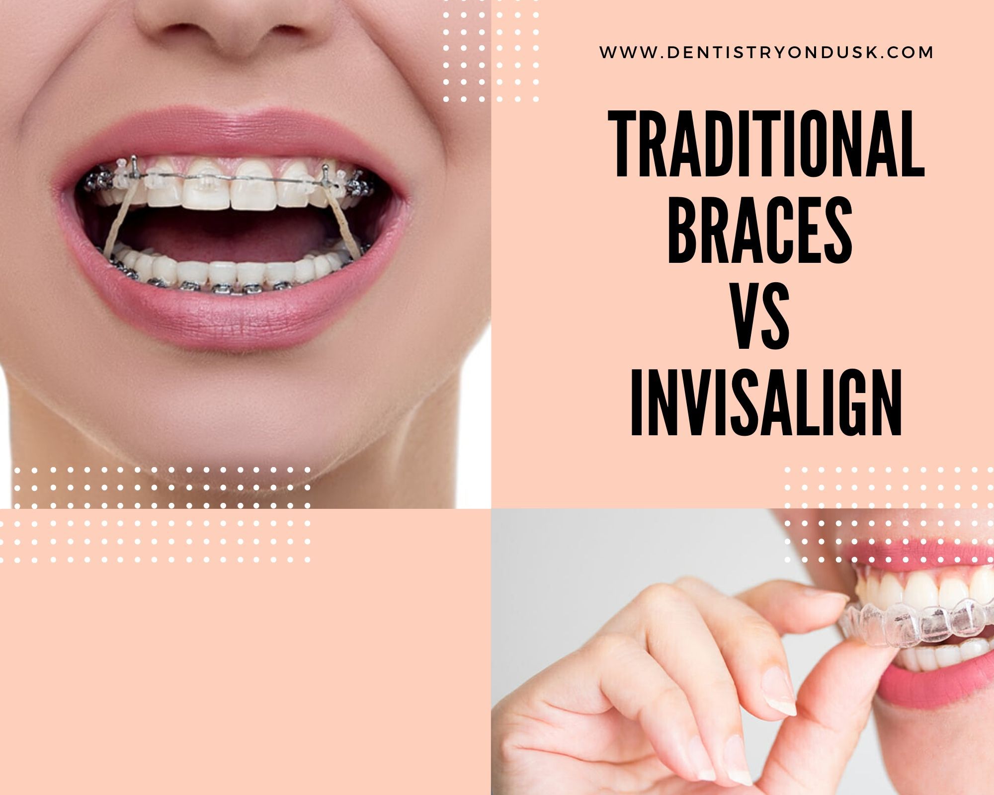 Invisalign vs. Traditional Braces: Which Is Right for You?